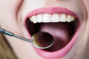 Cómo tratar y prevenir la gingivitis en casa